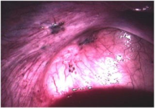 endometriosis superficial