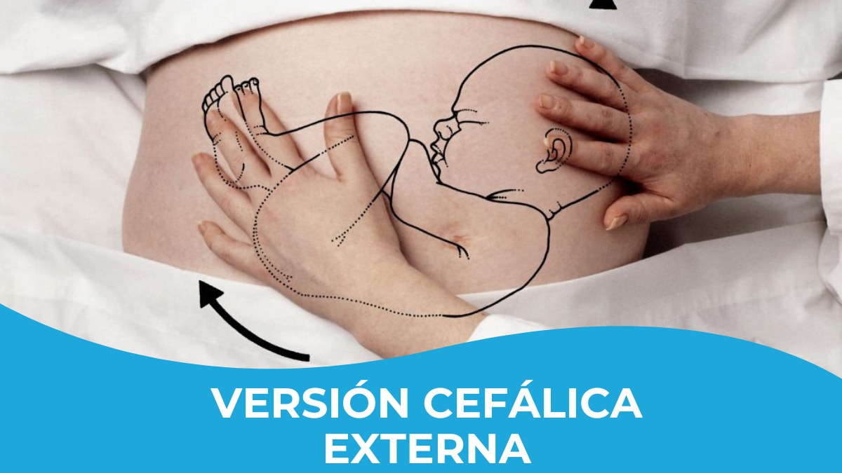 version-cefalica-externa-HM-Monteprincipe.jpg