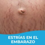 Estrias en el embarazo