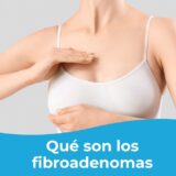 fibroadenomas